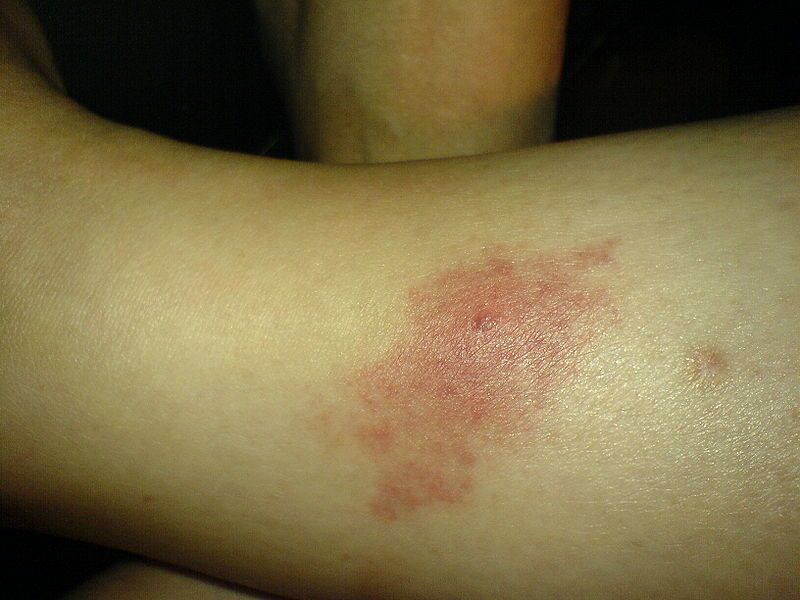 Sand Gnat bite on leg - Source